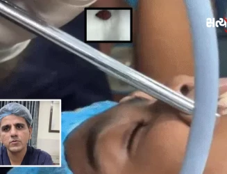 વડોદરામાં 8 વર્ષના બાળકની શ્વાસનળીમાંથી 6 મહિના બાદ બોરનો ઠળિયો બહાર કાઢાયો, તબીબોની ચેતવણી